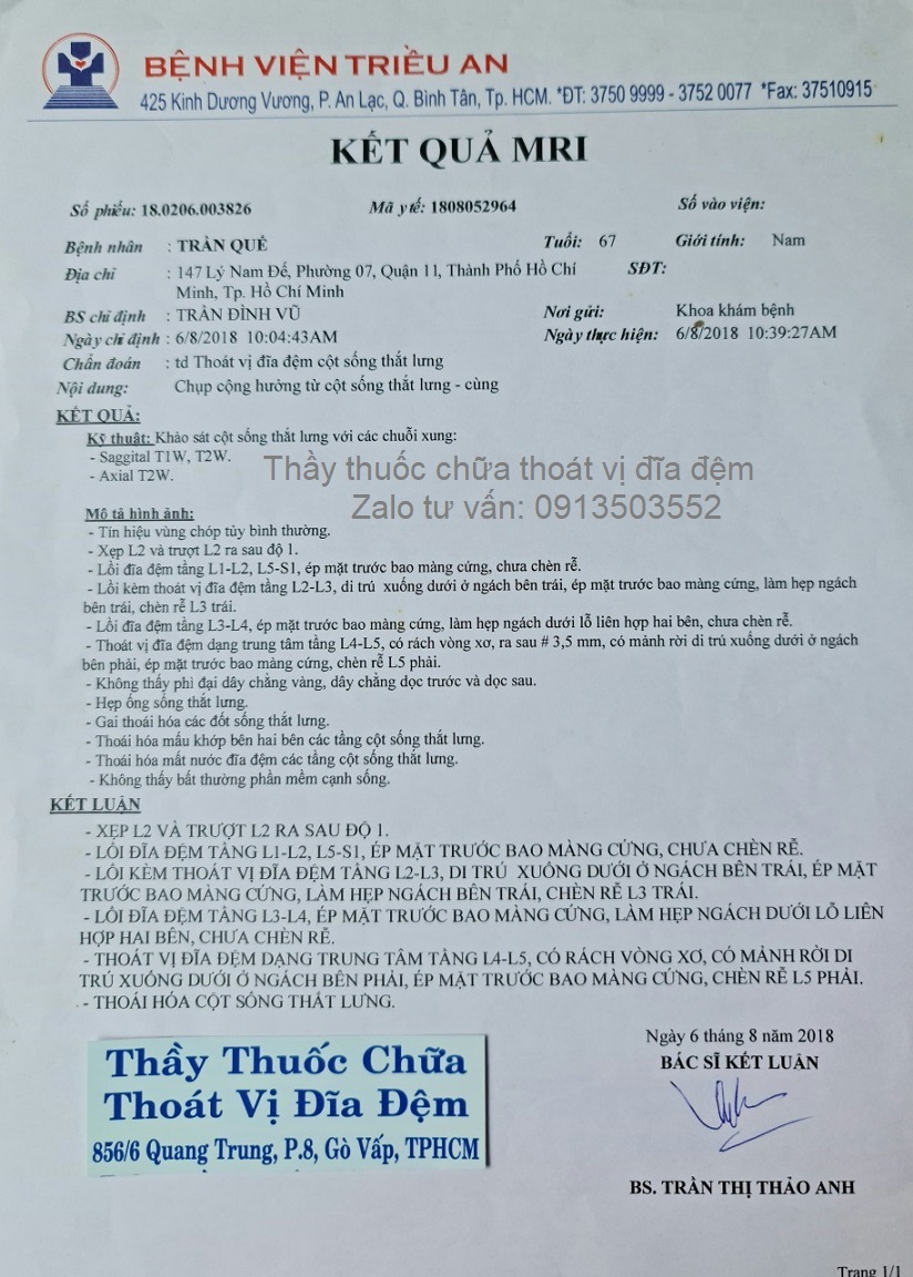 Thoát vị đĩa đệm chèn ép rễ L5